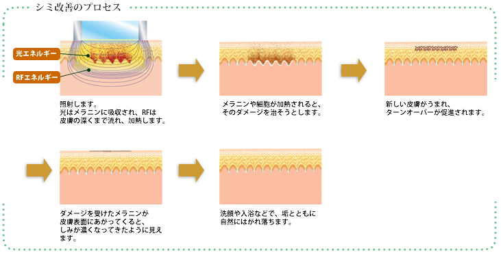 シミ改善のプロセス